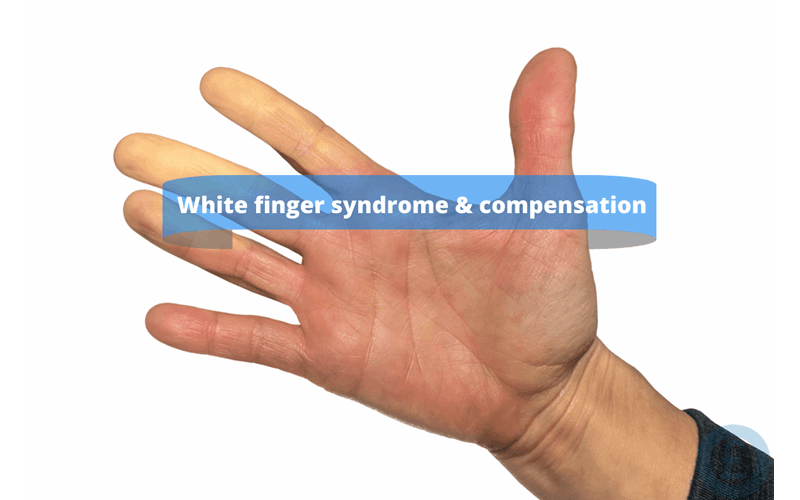 Money Savings Advice White finger syndrome & compensation